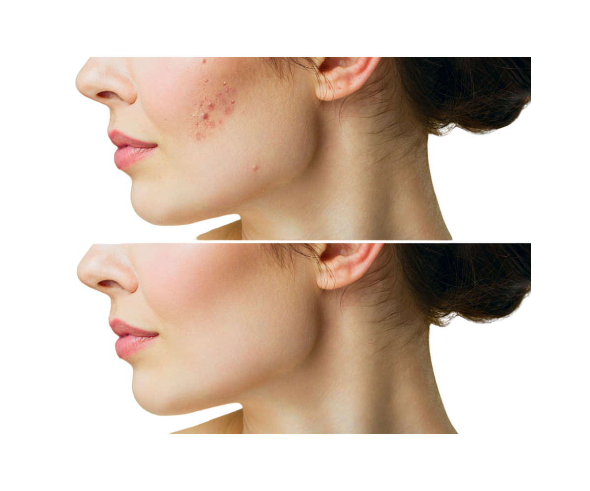 RLT For Scar Revision: Exploring Its Potential And Prospects