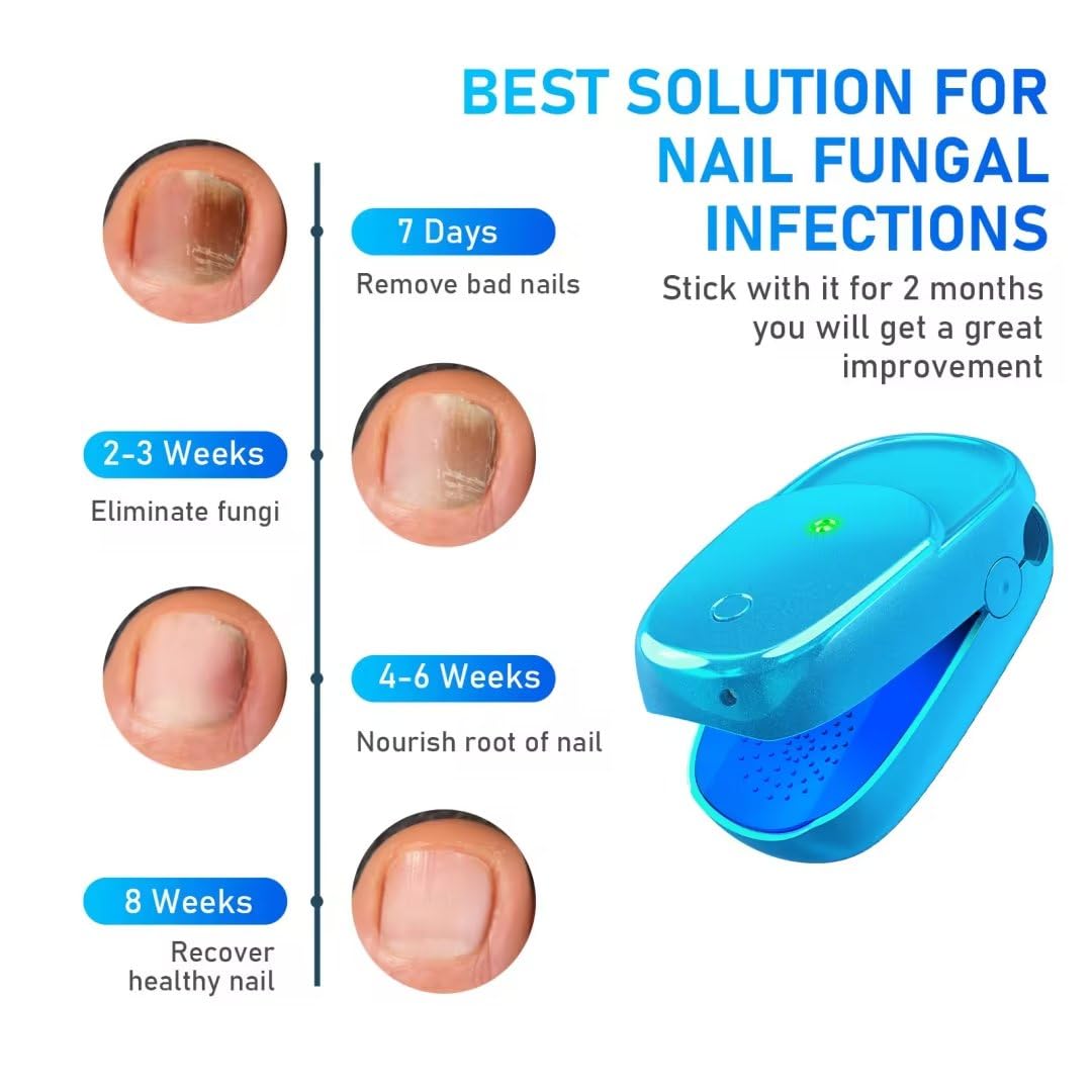 KTS® New Onychomycosis Laser Treatment Device