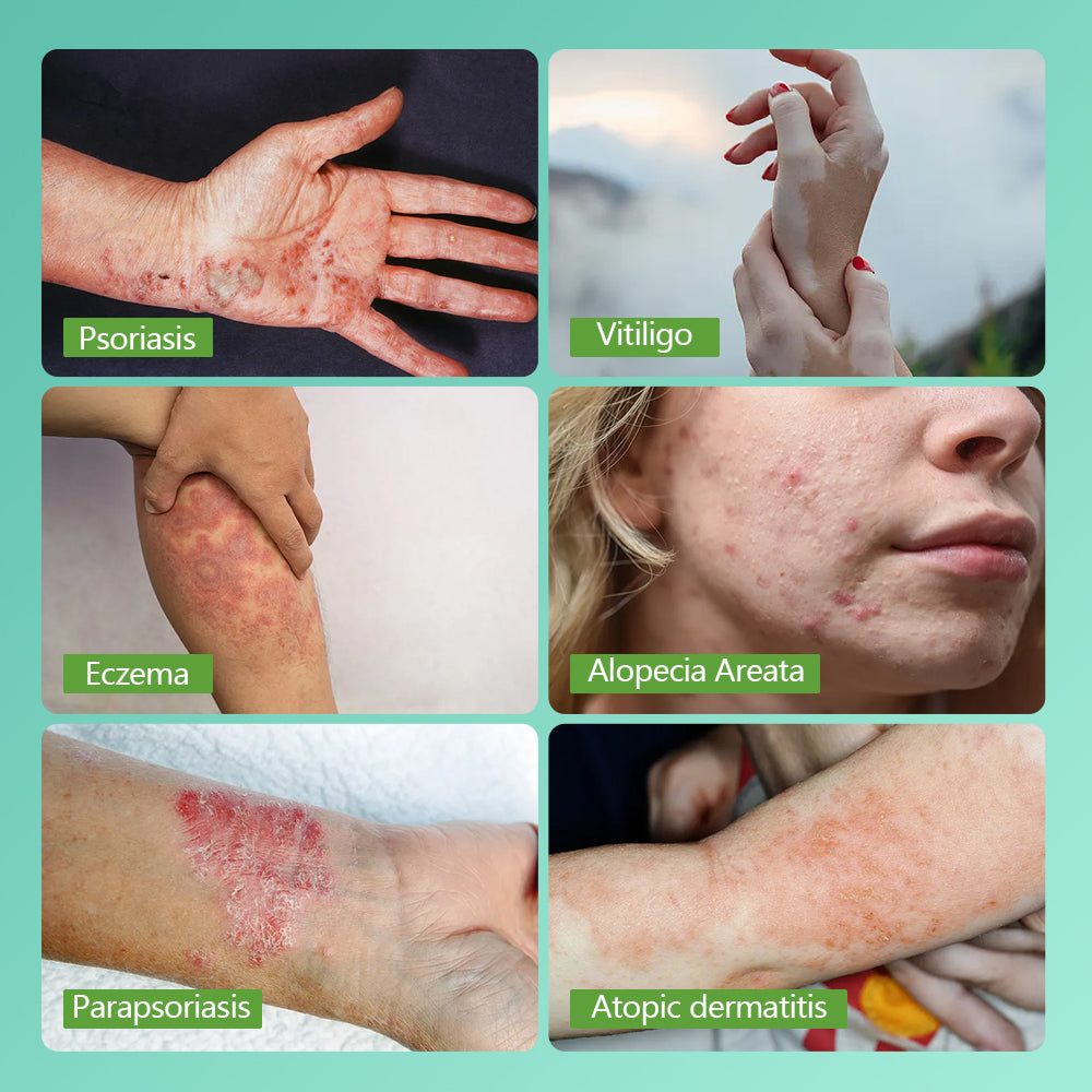 Philips Narrowband UVB Vitiligo/Psoriasis Light Therapy Device