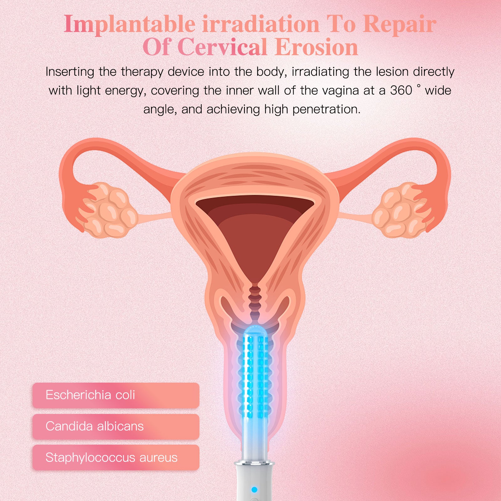 KTS® Portable Vaginal Rejuvenation Wand