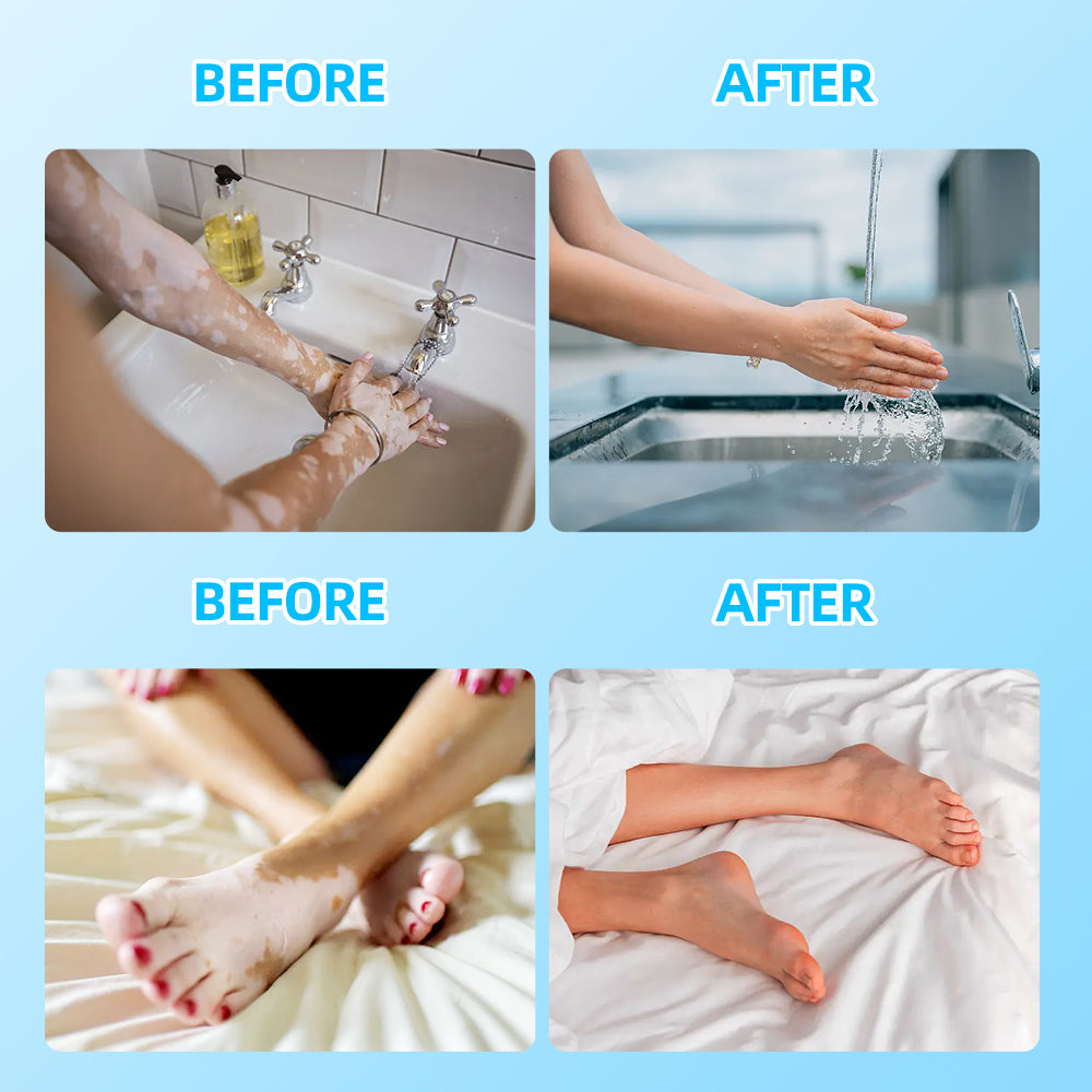 UVB Vitiligo/Psoriasis Light Therapy Device for Home