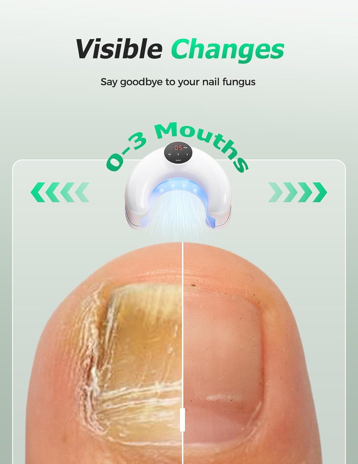 Wireless Nail Fungus Laser Treatment Devices for Multiple Toenails