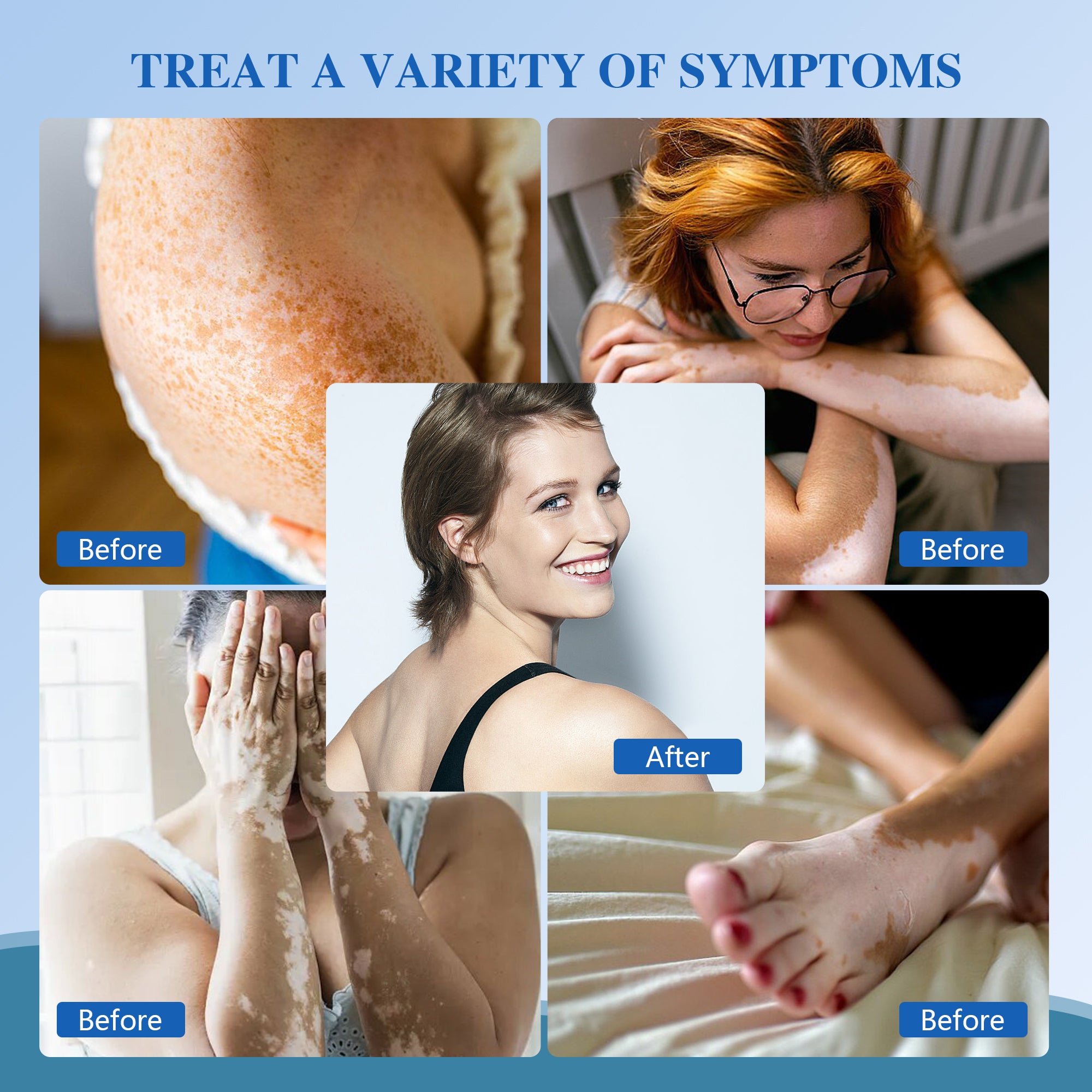 Best UVB Light Therapy Lamp - Home Treatment For Psoriasis, Eczema