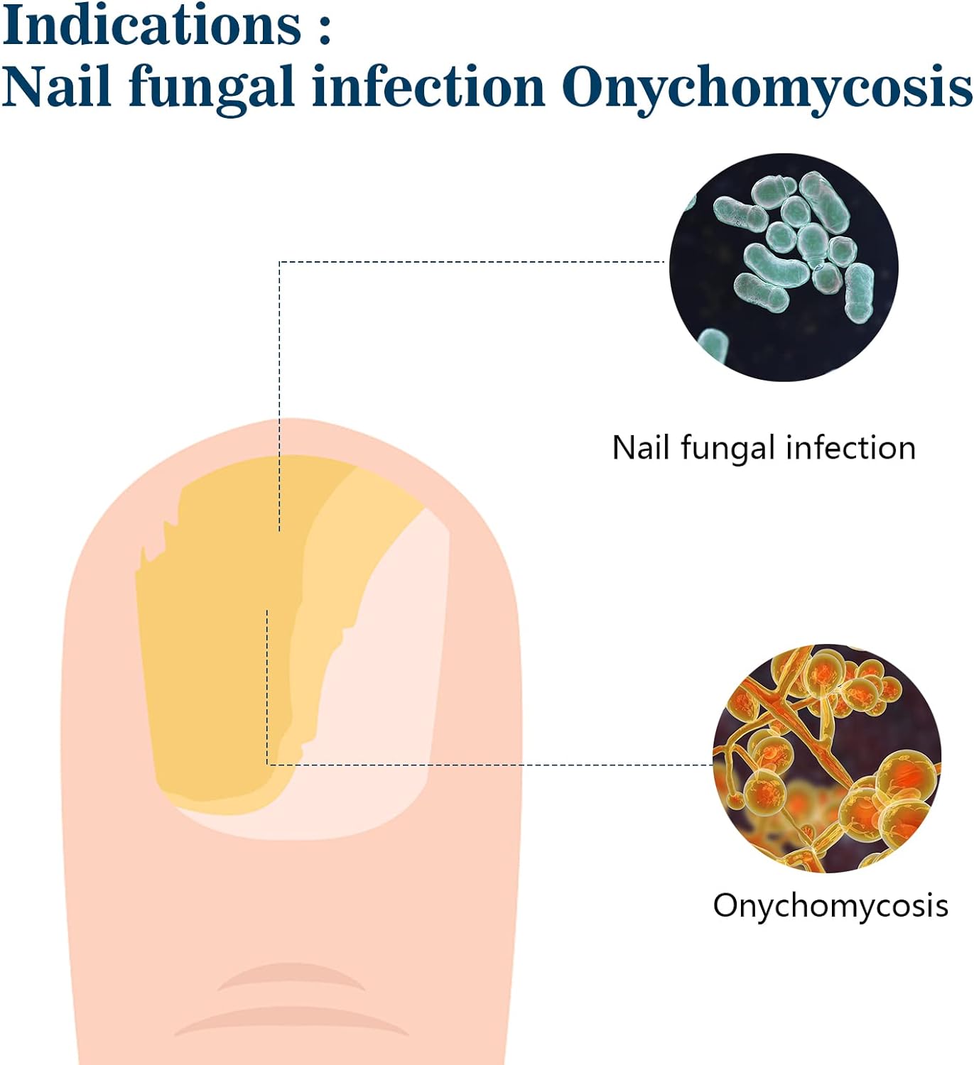 KTS® Nail Fungus Cleaning Device - Onychomycosis