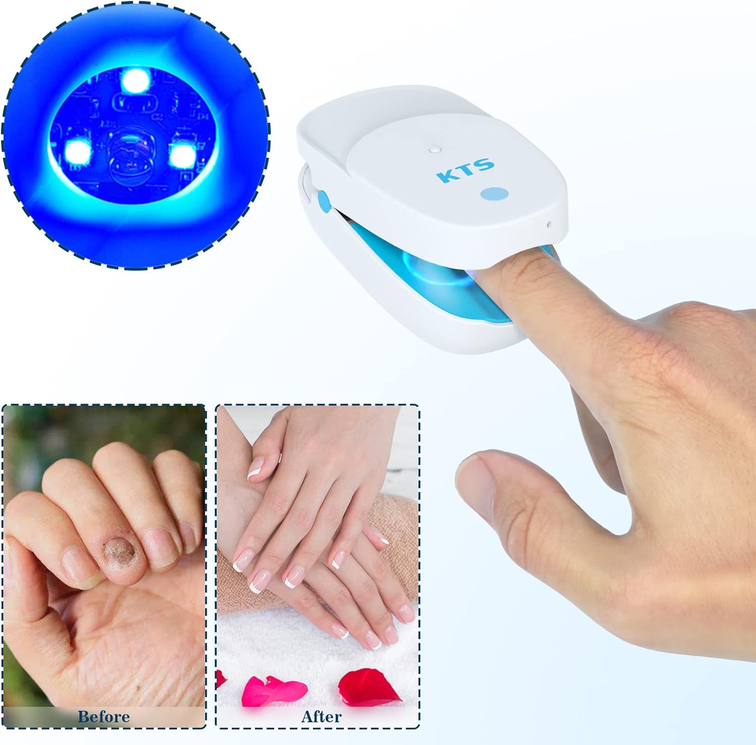 KTS® Nail Fungus Cleaning Device - Onychomycosis