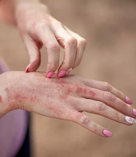 Dermatit