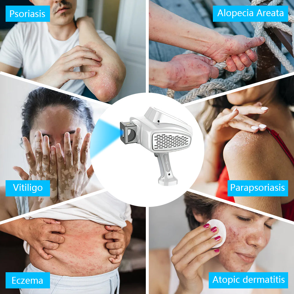 Best UVB Light Therapy Device - Home Treatment For Psoriasis